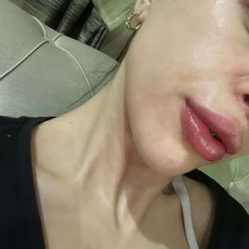 Dudak Dolgusu Sonrası Kalıcı Hasar Ve Mağduriyet