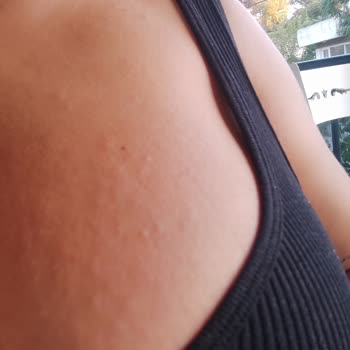 Bronzlaştırıcı Yağ Sonrası Kabarma Ve Kaşıntı Yaşadım Çözüm Bekliyorum