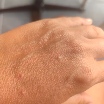 Bronzlaştırıcı Yağ Sonrası Kabarma Ve Kaşıntı Yaşadım Çözüm Bekliyorum