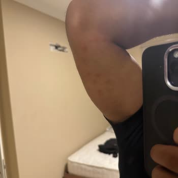 Tahta Kurusu Ve Haşereler Nedeniyle Sağlık Mağduriyeti Yaşadık