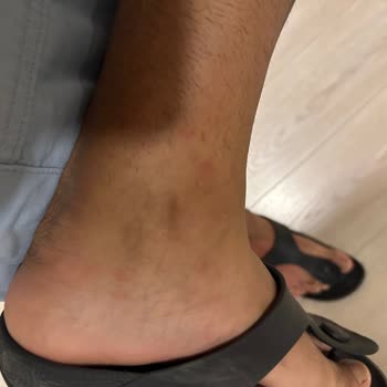 Tahta Kurusu Ve Haşereler Nedeniyle Sağlık Mağduriyeti Yaşadık