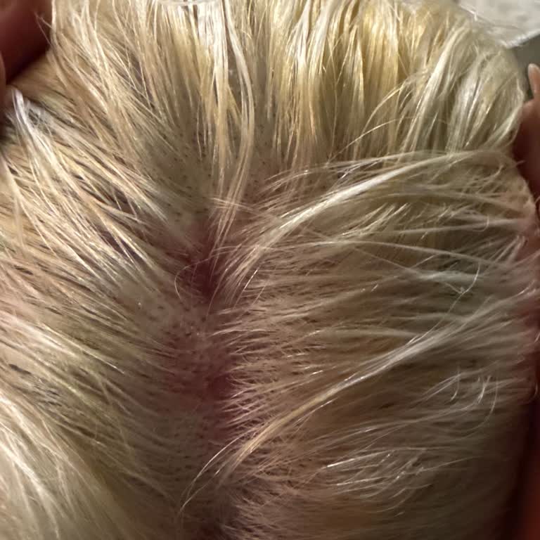 Saç Boyası Kullandıktan Sonra Saç Diplerimde Ciddi Yanıklar Ve Su Baloncukları Oluştu