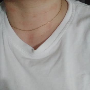 Krem Kullanımı Sonrası Artan Kızarıklık Ve Yanma Sorunu