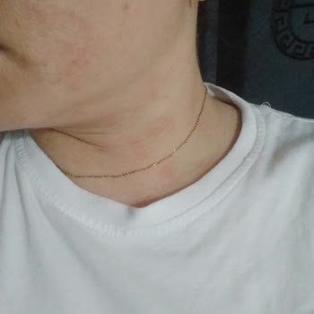 Krem Kullanımı Sonrası Artan Kızarıklık Ve Yanma Sorunu