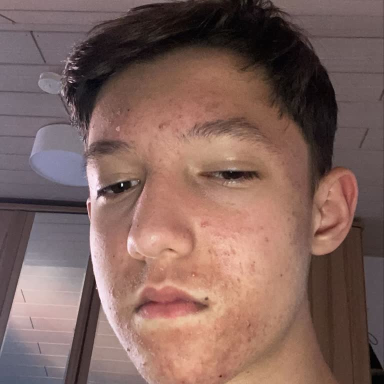 Esthederm Propolis Kaolin Maske Ciddi Cilt Lekelerine Yol Açtı, Acil Destek Bekliyoruz