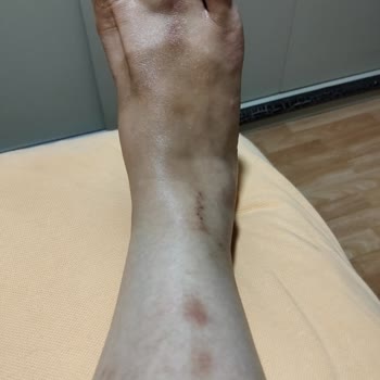 Epify Tüy Dökücü Krem Şiddetli Alerjik Reaksiyon Ve Mağduriyet