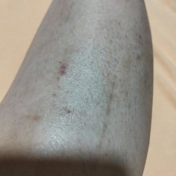 Epify Tüy Dökücü Krem Şiddetli Alerjik Reaksiyon Ve Mağduriyet