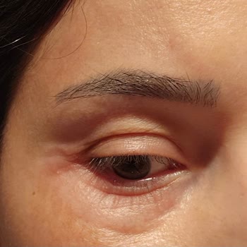 Göz Kremi Metal Başlığı Alerjiye Sebep Oldu, Değişim Ve Özür Talebim Var