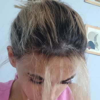 Yüksek Ücret, Kötü Sonuç: Saçım Mahvoldu, Ücret İadesi İstiyorum