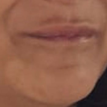 Doç. Dr. Sıla Kılıç Sayar Dolgu ve Botoksta Yapılan Hata