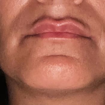 Doç. Dr. Sıla Kılıç Sayar Dolgu ve Botoksta Yapılan Hata