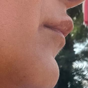 Doç. Dr. Sıla Kılıç Sayar Dolgu ve Botoksta Yapılan Hata