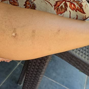 Sevgi Güzellik Salonu (İzmir) Lazer Sonrası Yanık