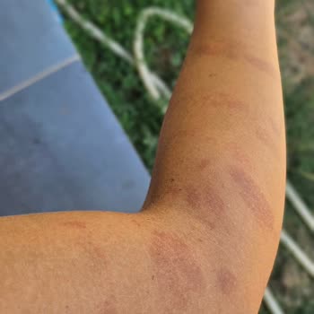 Sevgi Güzellik Salonu (İzmir) Lazer Sonrası Yanık