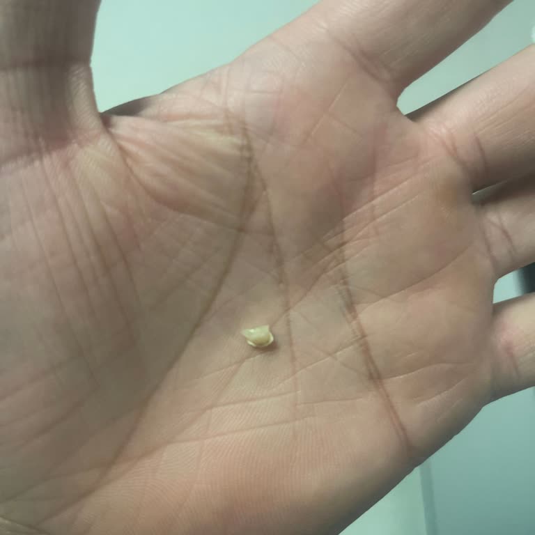 Eksik Ve Kalitesiz Diş Dolgusu Sonucu Mağduriyet