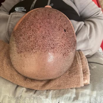 Saç Ekimi Sonrası İlgisizlik Ve Hayal Kırıklığı