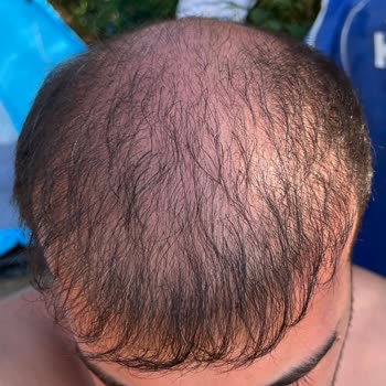 Saç Ekimi Sonrası İlgisizlik Ve Hayal Kırıklığı