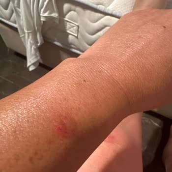 Yoğun Bronzlaştırıcı Yağ Ciddi Alerjik Reaksiyonlara Ve Yanıklara Sebep Oldu