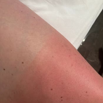 Yoğun Bronzlaştırıcı Yağ Ciddi Alerjik Reaksiyonlara Ve Yanıklara Sebep Oldu