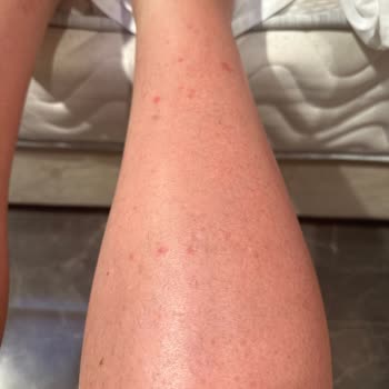 Yoğun Bronzlaştırıcı Yağ Ciddi Alerjik Reaksiyonlara Ve Yanıklara Sebep Oldu