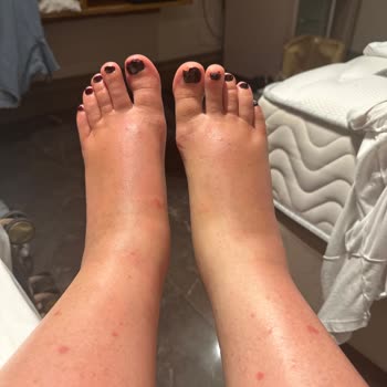 Yoğun Bronzlaştırıcı Yağ Ciddi Alerjik Reaksiyonlara Ve Yanıklara Sebep Oldu