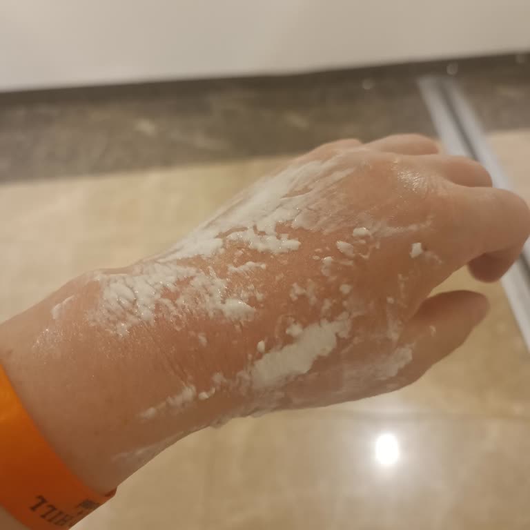 Otel Restoranında Yanık Kazası Sonrası Yetersiz Sağlık Desteği