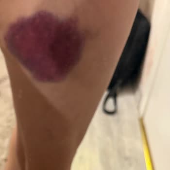 Güvensiz Merdivenler Yüzünden Yaşadığım Kaza Ve İlgisiz Mağaza Personeli