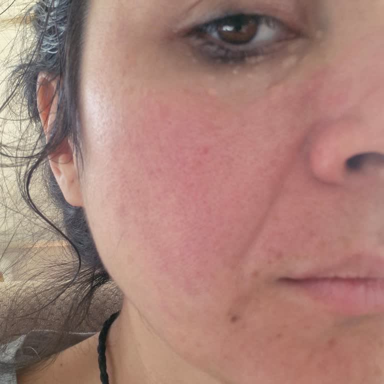 Schwere Hautreizung durch Neutrogena Peeling Gel
