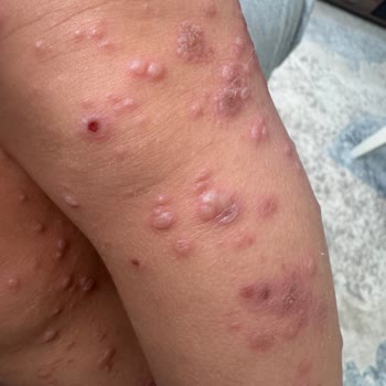 Otel Havuzundan Bulaşan Hastalık Nedeniyle Tatilimizi Mahvoldu