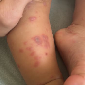 Otel Havuzundan Bulaşan Hastalık Nedeniyle Tatilimizi Mahvoldu