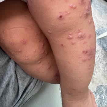 Otel Havuzundan Bulaşan Hastalık Nedeniyle Tatilimizi Mahvoldu