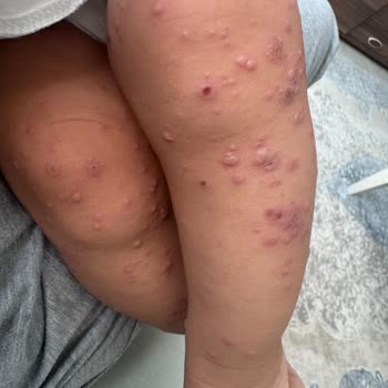 Otel Havuzundan Bulaşan Hastalık Nedeniyle Tatilimizi Mahvoldu