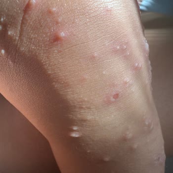 Otel Havuzundan Bulaşan Hastalık Nedeniyle Tatilimizi Mahvoldu