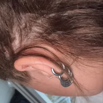 Saç Kaynak İşleminde Aldatıldım, Hem Maddi Hem Manevi Mağdur Oldum