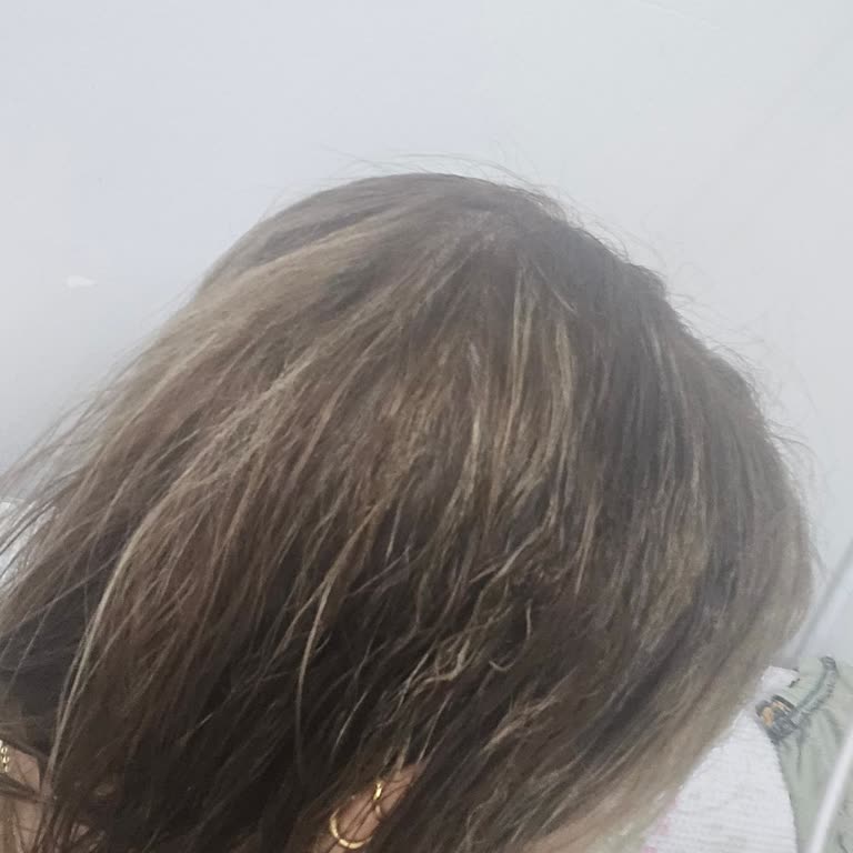 Kuaför Saç Boyama Sonrası Yanık Ve Hasar Mağduriyeti