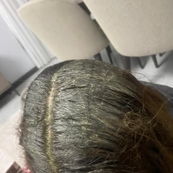 Aldığım Saç Boyası Saçımda İstenmeyen Renk Ve Cilt Reaksiyonu Oluşturdu