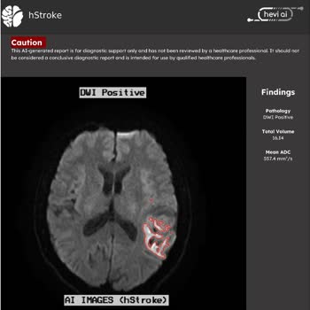 Acil Serviste Yetersiz Muayene Sonucu Beyin Kanaması Teşhisi Gecikti
