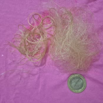 Saç Boyası Sonrası Ciddi Saç Dökülmesi Ve Mağduriyet Yaşadım