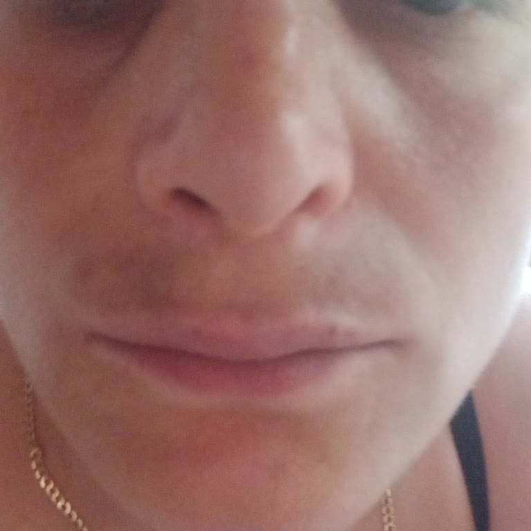 Yanlış Uygulama Sonrası Kalıcı Cilt Lekeleri Ve Para İadesi Sorunu