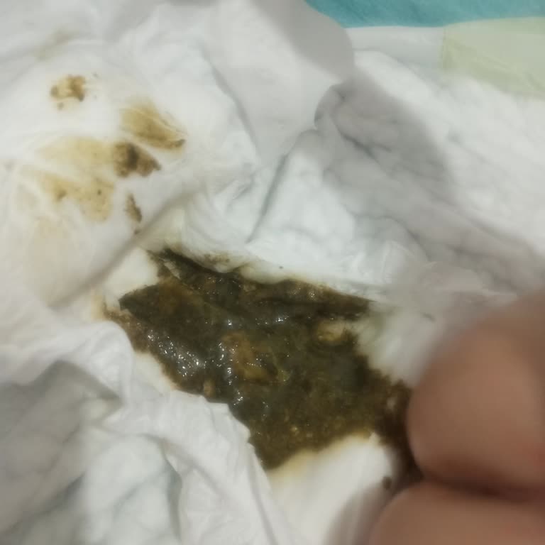 Aptamil 2 Devam Sütü Kullandıktan Sonra Çocuğumda İshal Ve Kusma Başladı