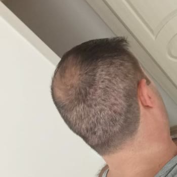 Saç Ekimi Sonrası Sorunlarım Çözülmedi, Mağduriyetim Giderilmiyor