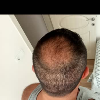 Saç Ekimi Sonrası Sorunlarım Çözülmedi, Mağduriyetim Giderilmiyor