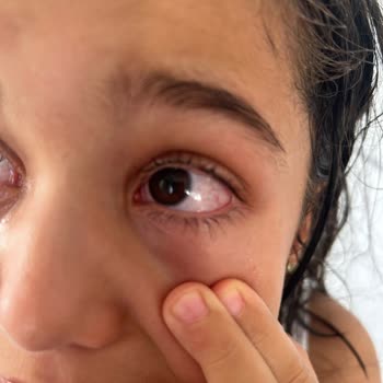 Patlayan Kefir Çocuğumun Yüzüne Sıçradı Elektronik Eşyalar Zarar Gördü Endişeliyim