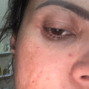 Missha Güneş Kremi Cildimde Ciddi Sorunlara Yol Açtı, Yetersiz Müşteri Desteği