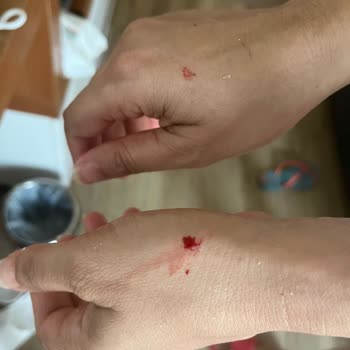 Otel Odasında Patlayan Duş Kabini Sonrası Yaşanan Güvenlik Ve Mağduriyet