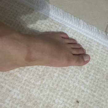 Aldığım Spor Ayakkabı Ciddi Vurma Ve Alerjiye Yol Açtı