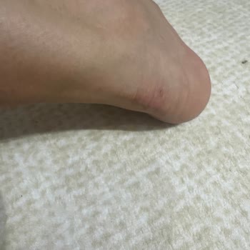 Aldığım Spor Ayakkabı Ciddi Vurma Ve Alerjiye Yol Açtı