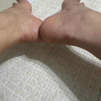 Aldığım Spor Ayakkabı Ciddi Vurma Ve Alerjiye Yol Açtı