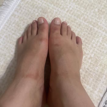 Aldığım Spor Ayakkabı Ciddi Vurma Ve Alerjiye Yol Açtı