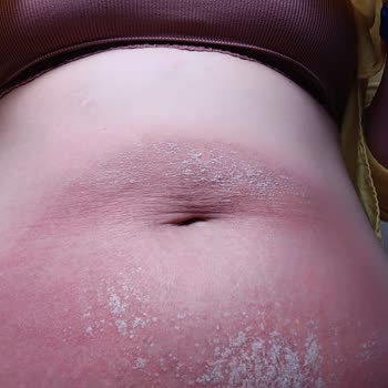 Estetic Clinic (estetic.com.tr) İşlem Sonrası Cildimde İzler Oluştu